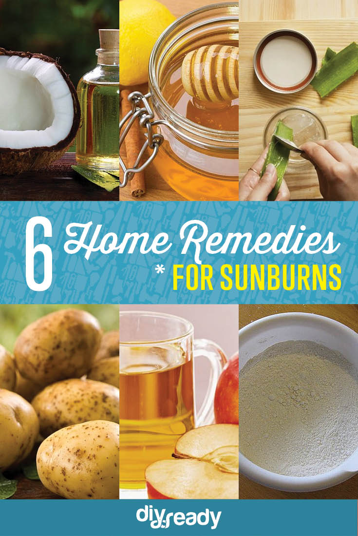 6 Home Remedies for Sunburn
