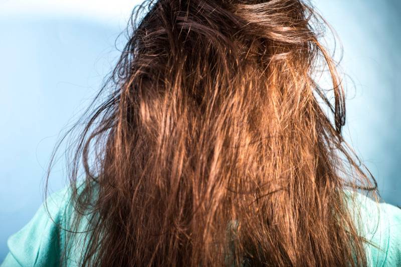 problem-scalp-greasy-dirty-hair-girl | homemade shampoo